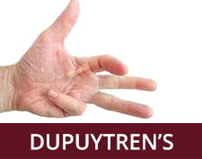 Dupuytren’s